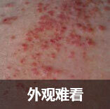 惊!六成人曾患过湿疹